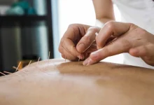 عملية العلاج بالإبر