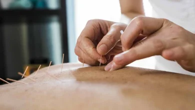 عملية العلاج بالإبر