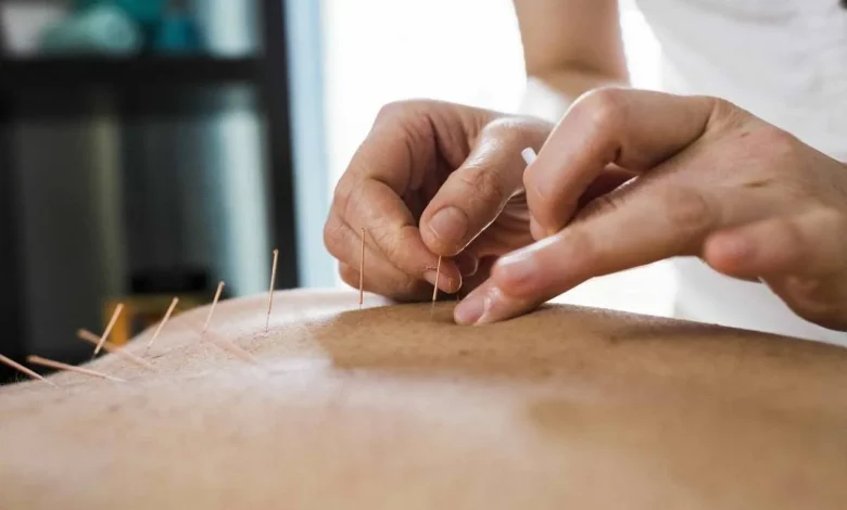 عملية العلاج بالإبر